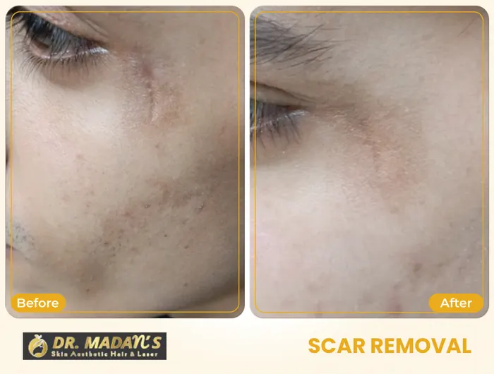 Scar removal before and after result 6 at Dr Madan Aesthetics